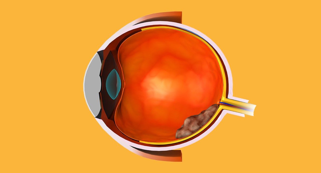 Retinoblastoma tumor in the retina of the eye